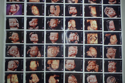 7 yıllık bebek hasreti "kişiye özel" tedaviyle son buldu
