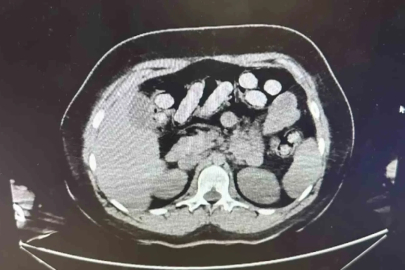 1.5 kilo metamfetamin iki kadın kuryenin bağırsak ve midesinden çıktı
